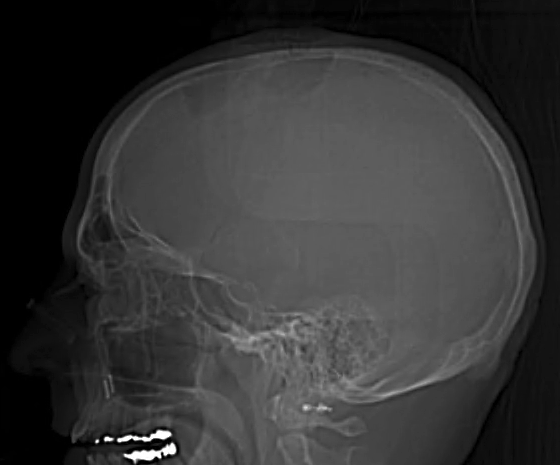 Malakoplakia with multisystem involvement | Image | Radiopaedia.org