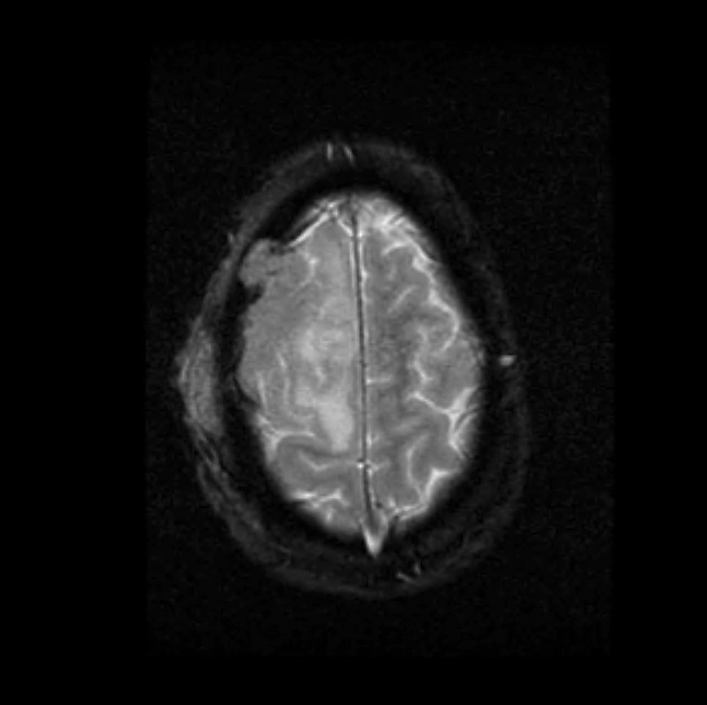 Malakoplakia with multisystem involvement | Image | Radiopaedia.org