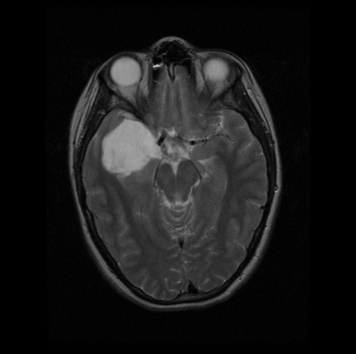 Epidermoid Cyst Of The Middle Cranial Fossa Image 1901