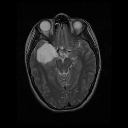 Epidermoid Cyst Of The Middle Cranial Fossa Image Radiopaedia Org