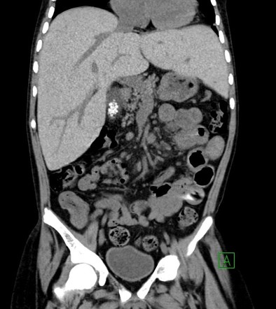 Hemochromatosis with hyperdense liver | Image | Radiopaedia.org