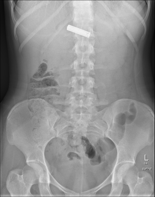 Swallowed foreign body | Radiology Case | Radiopaedia.org