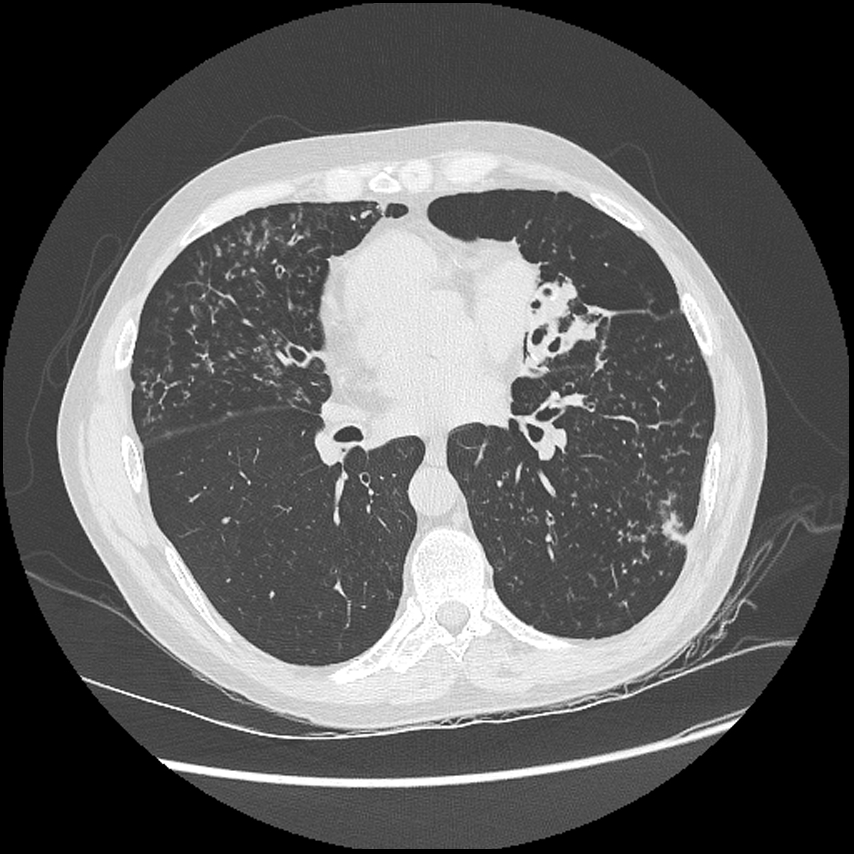 Kartagener syndrome | Image | Radiopaedia.org