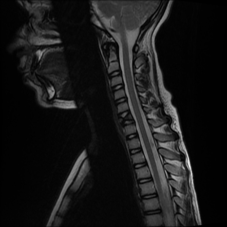 Butterfly vertebra | Radiology Case | Radiopaedia.org