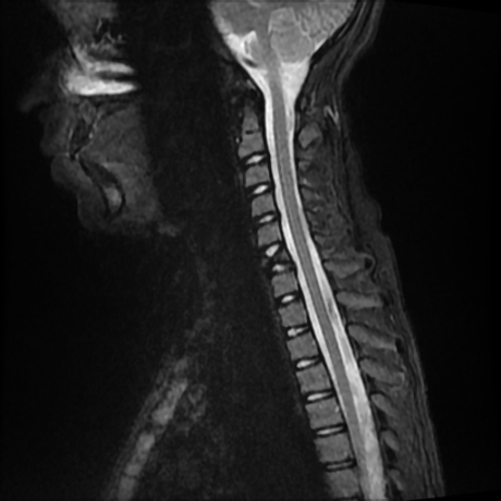 Butterfly vertebra | Image | Radiopaedia.org