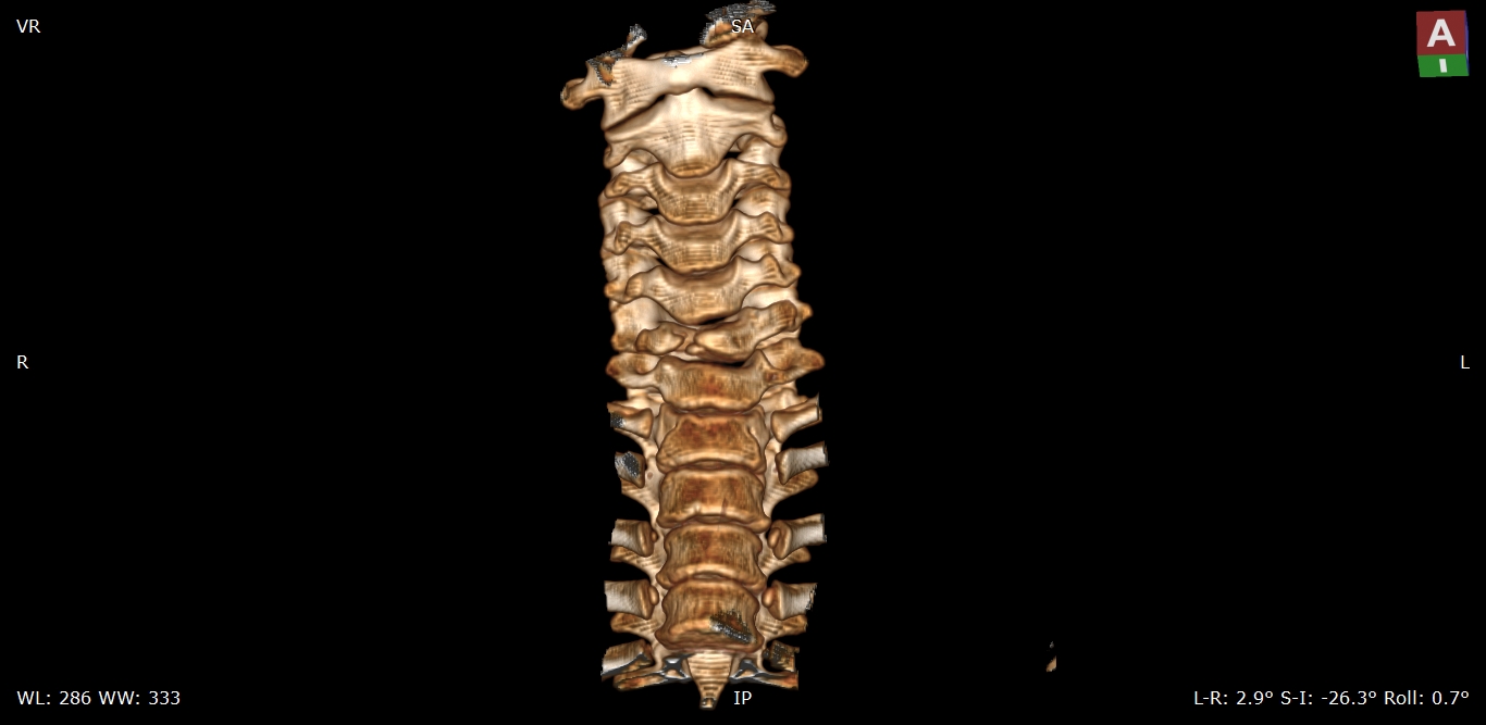 Butterfly vertebra Image