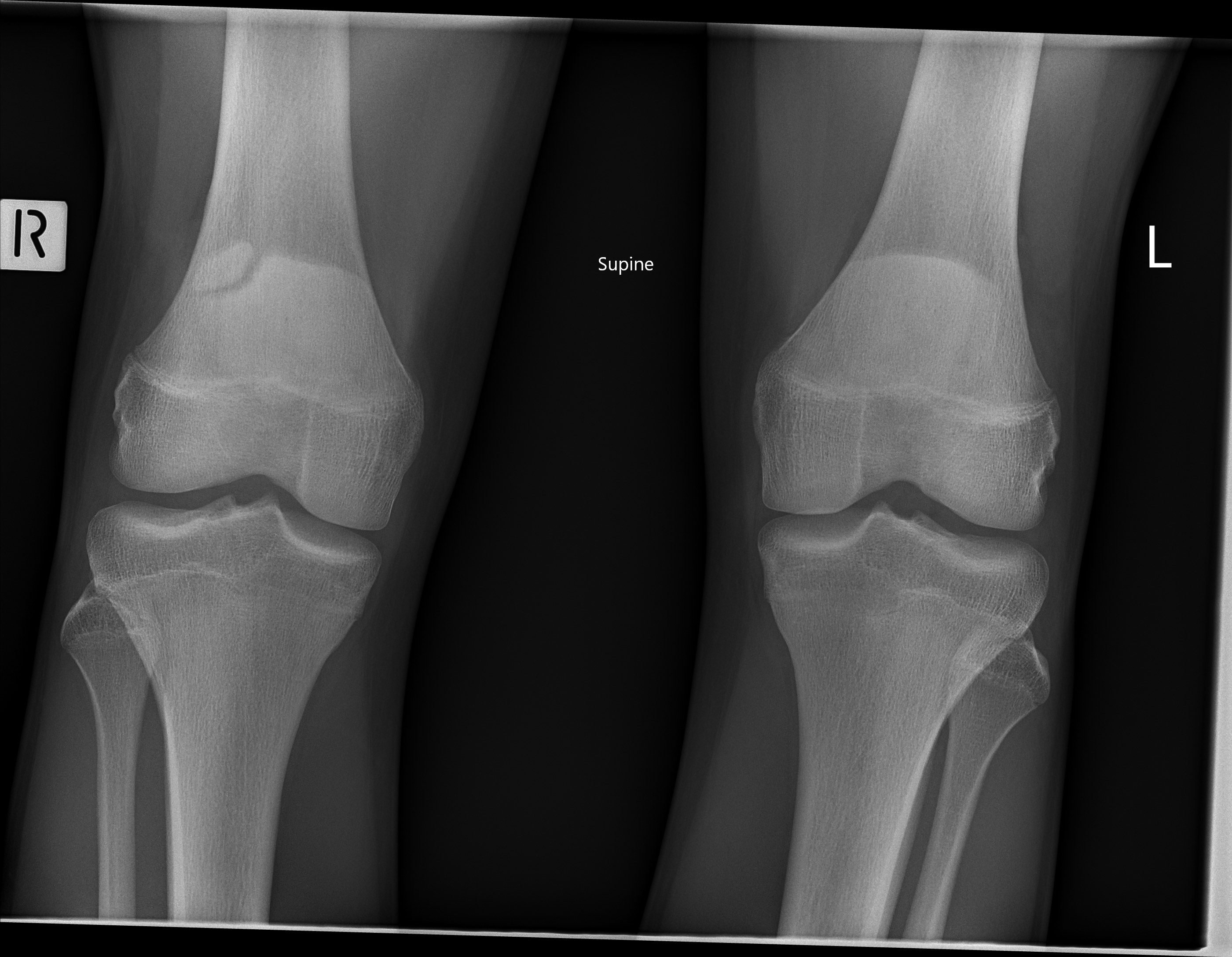 Bipartite patella - symptomatic | Image | Radiopaedia.org