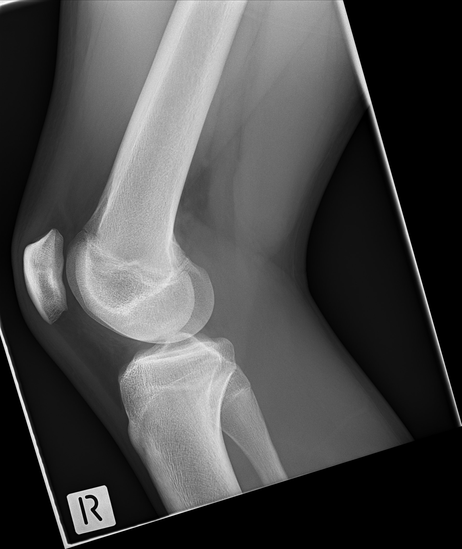 Bipartite Patella - Symptomatic | Image | Radiopaedia.org