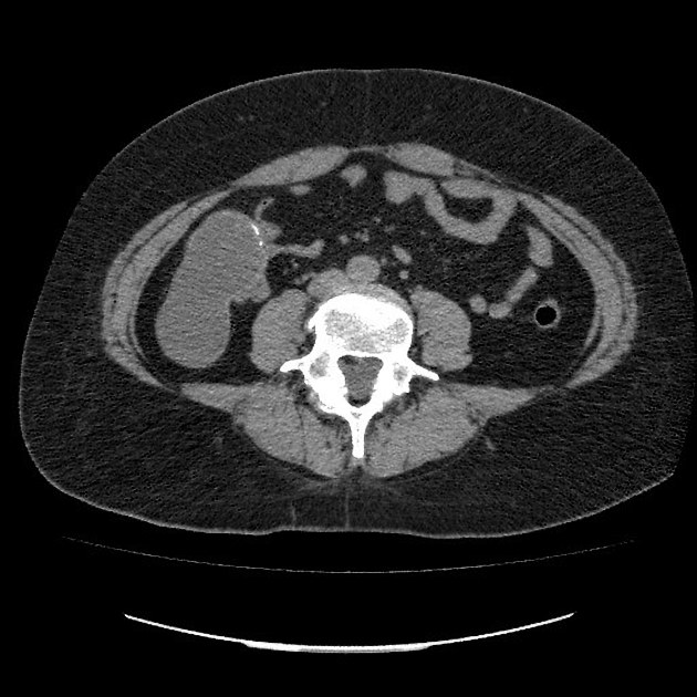 Featured image of post Appendix Mucocele Radiopaedia The term mucocele is simply a macroscopic description of an appendix that is grossly distended by mucus 7 12