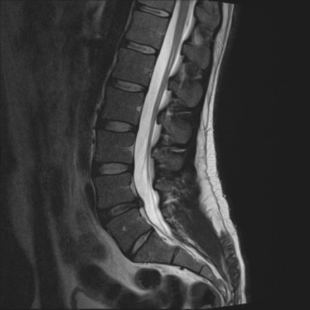 Lumbar extrusion - good lumbar numbering example | Radiology Case ...