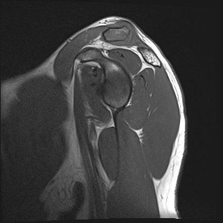 Post-traumatic distal clavicular osteolysis | Image | Radiopaedia.org