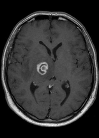 Cerebral toxoplasmosis | Radiology Case | Radiopaedia.org