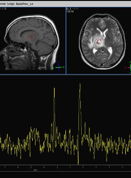 Cerebral toxoplasmosis | Image | Radiopaedia.org