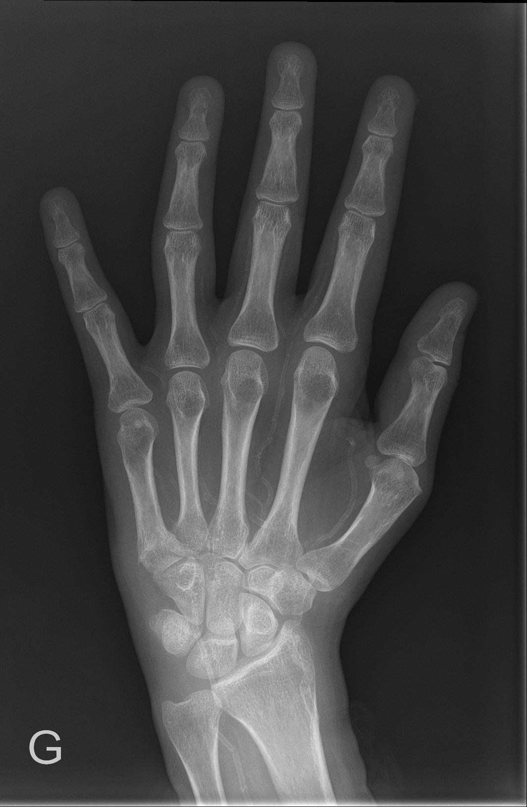 Mönckeberg medial calcific sclerosis | Image | Radiopaedia.org