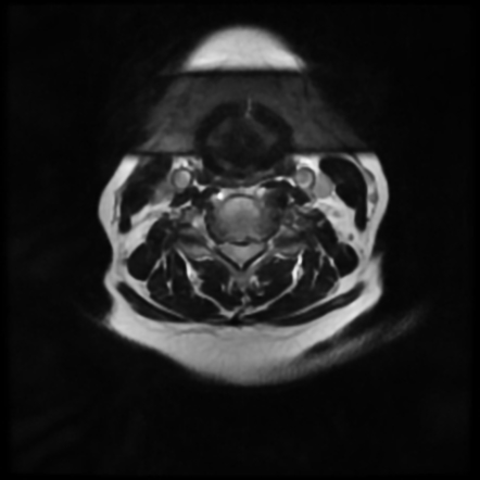 Transverse myelitis - cervical | Image | Radiopaedia.org