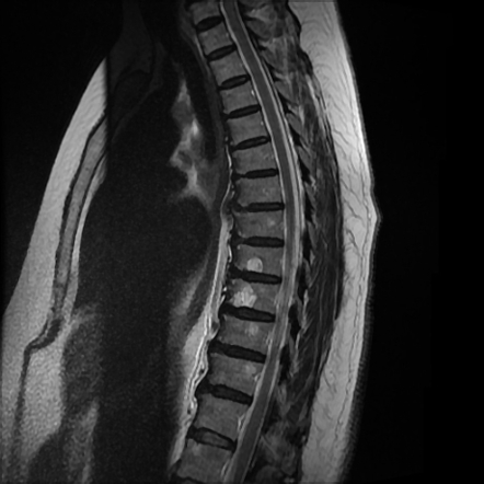 Transverse myelitis - cervical | Image | Radiopaedia.org