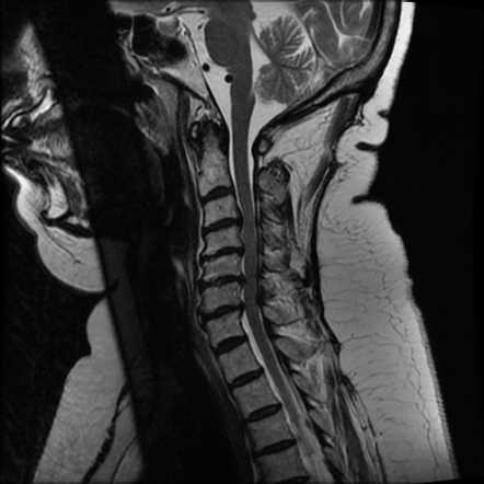 Transverse myelitis - cervical | Image | Radiopaedia.org