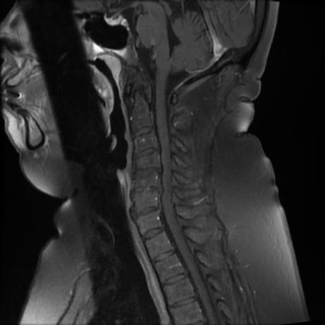 Transverse myelitis - cervical | Image | Radiopaedia.org