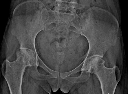 Ficat and Arlet classification of avascular necrosis of femoral head ...