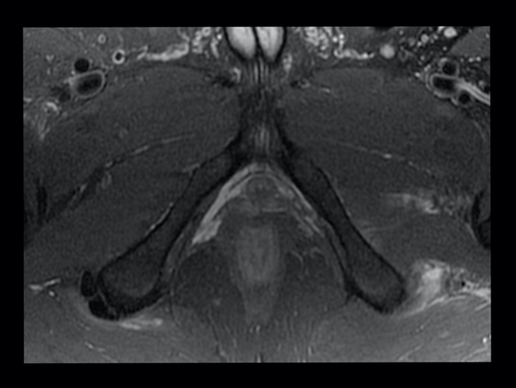 Complete left common hamstrings origin avulsion and left gracilis ...