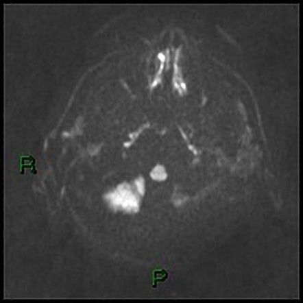 Parietal lobe arteriovenous malformation | Image | Radiopaedia.org