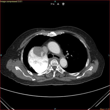 Enlarged azygos vein | Radiology Reference Article | Radiopaedia.org