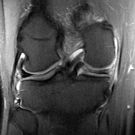 Double PCL sign | Radiology Reference Article | Radiopaedia.org