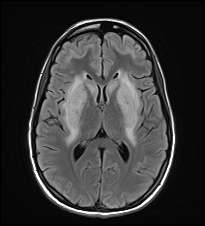 Methanol poisoning | Image | Radiopaedia.org