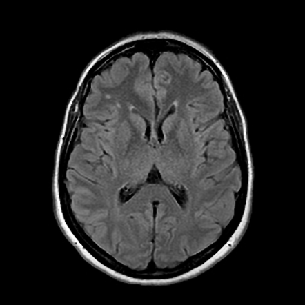 Tumefactive demyelinating lesion | Radiology Case | Radiopaedia.org