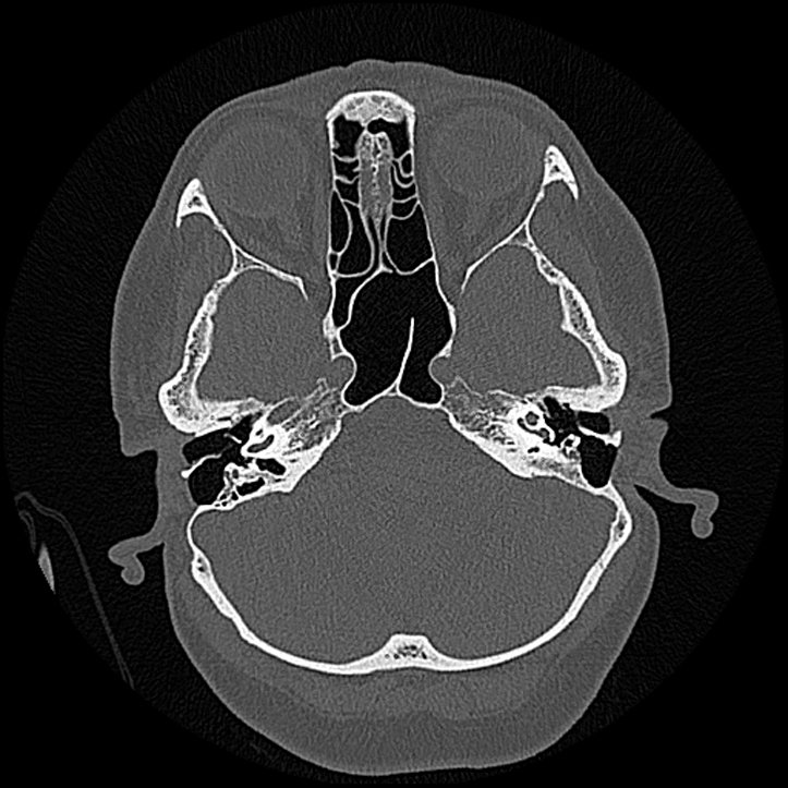 Canal Up Mastoidectomy | Image | Radiopaedia.org