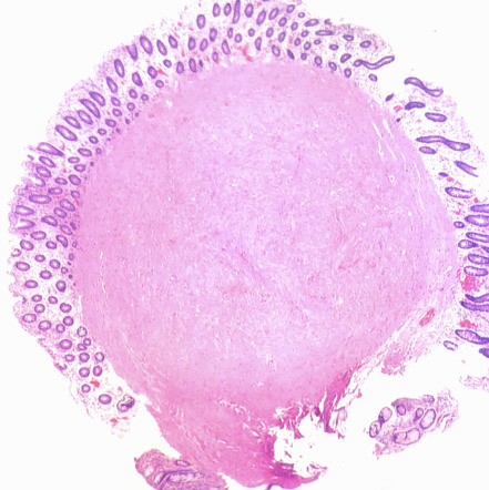 leiomyoma of descending colon icd 10