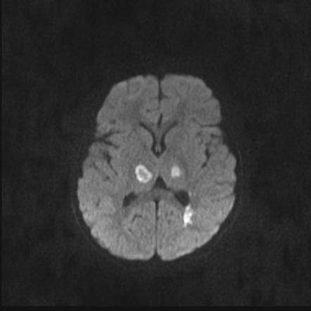 Acute necrotizing encephalitis | Radiology Case | Radiopaedia.org