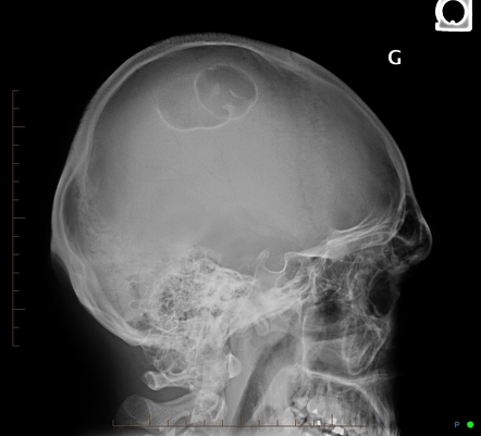 Intradiploic epidermoid cyst | Radiology Case | Radiopaedia.org