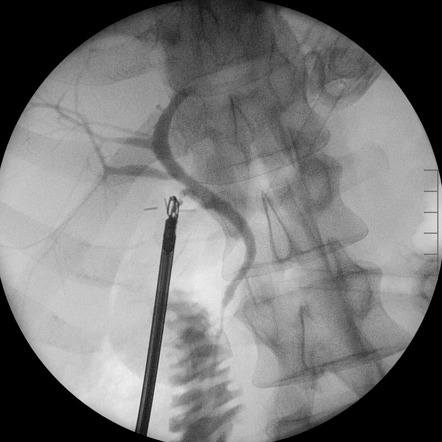 Intraoperative cholangiogram post cholecystectomy - normal | Radiology ...