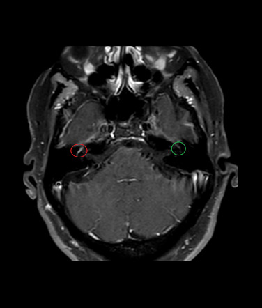 Bell Palsy 