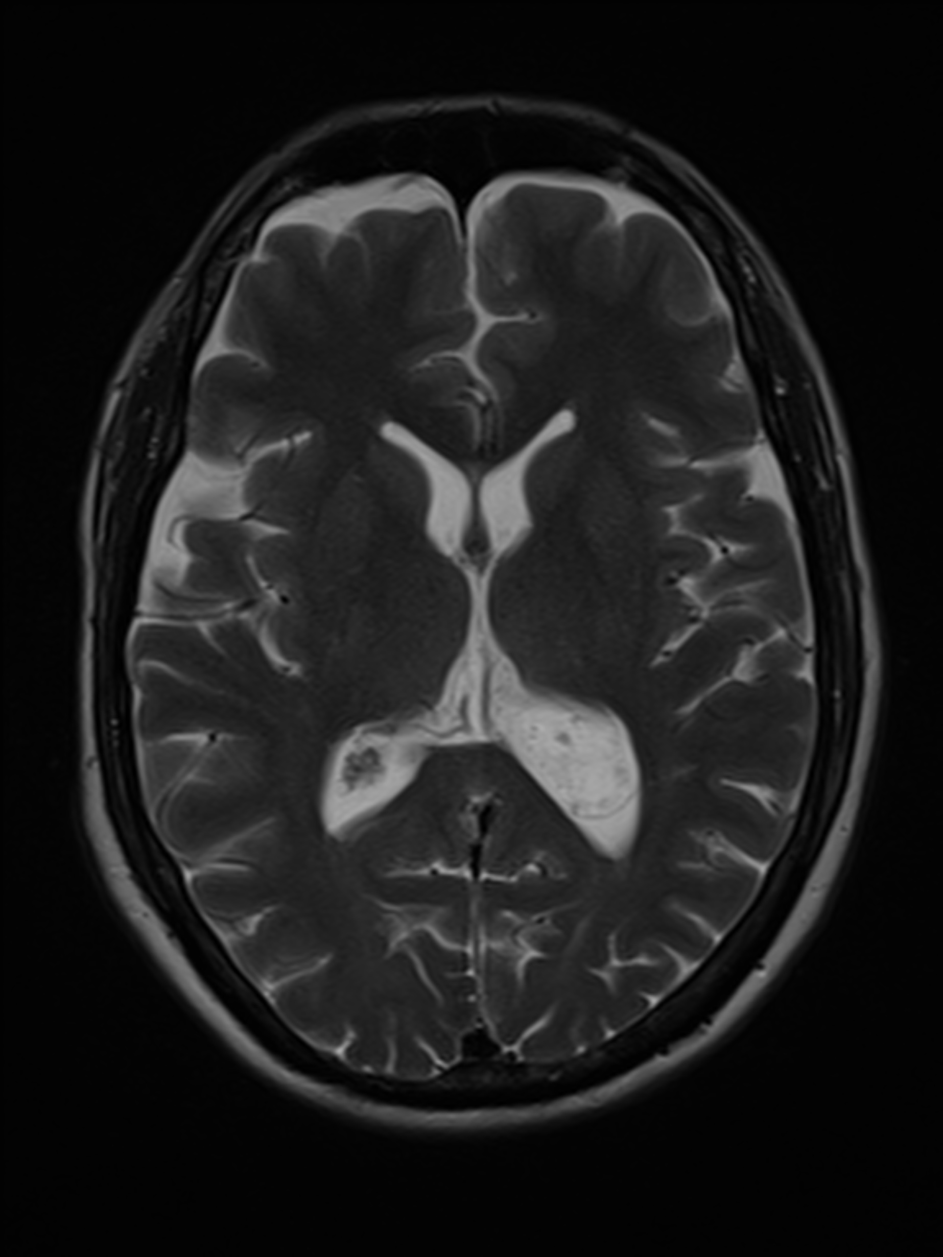 Large choroid plexus xanthogranuloma | Image | Radiopaedia.org