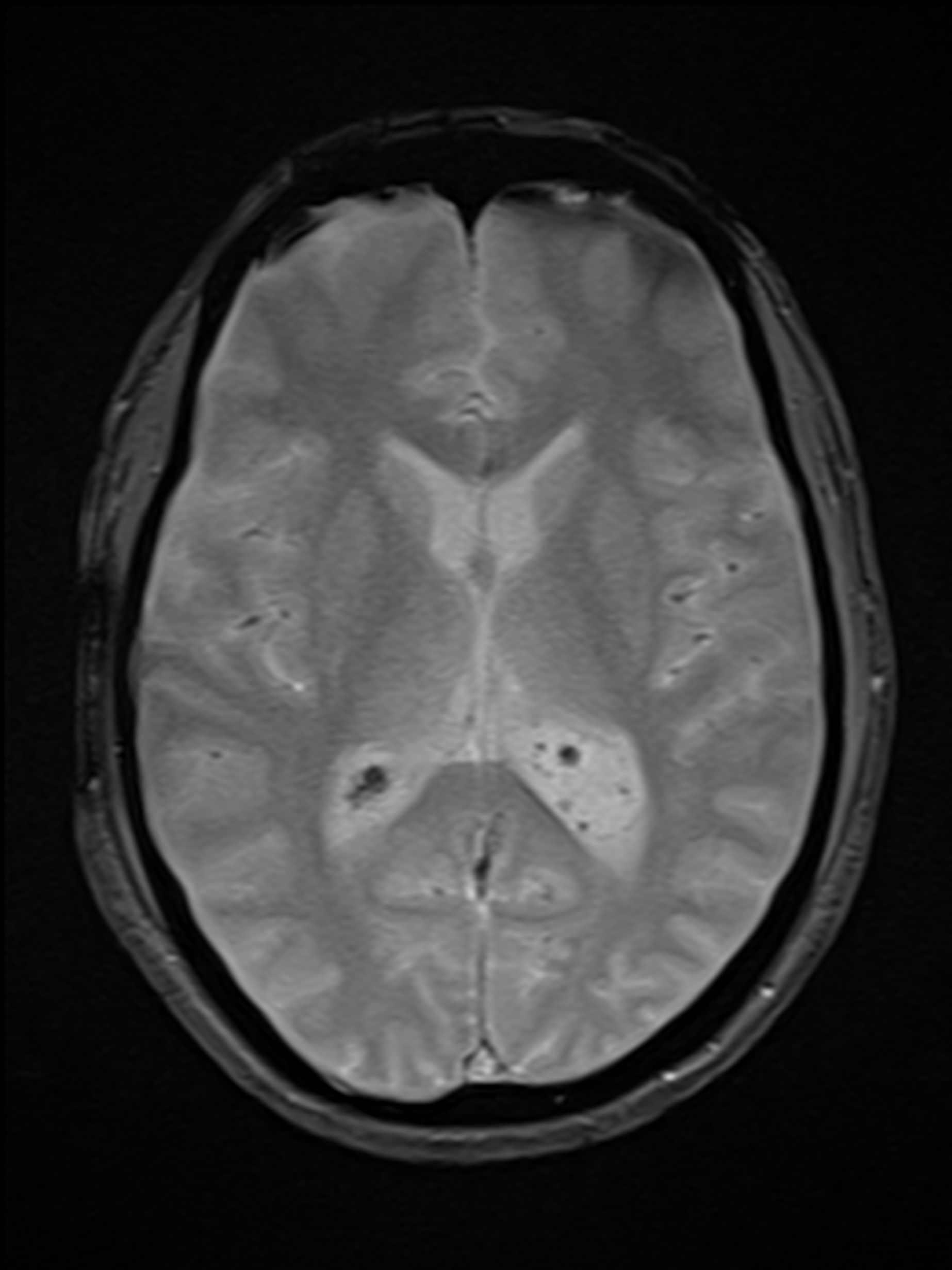 Large choroid plexus xanthogranuloma | Image | Radiopaedia.org