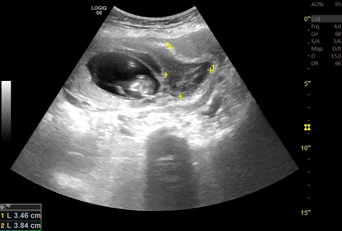 Subchorionic hemorrhage | Image | Radiopaedia.org