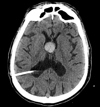 Colloid cyst of the 3rd ventricle | Radiology Case | Radiopaedia.org