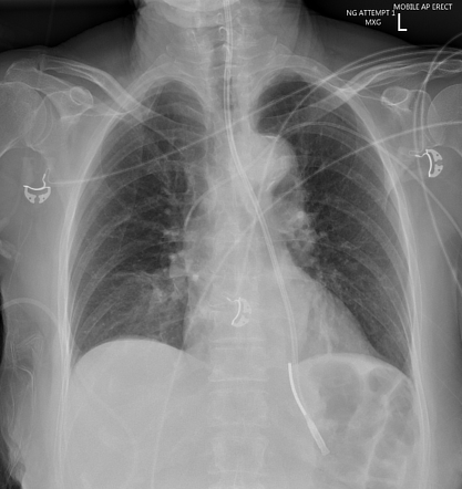 Nasogastric tube positioning | Radiology Reference Article ...