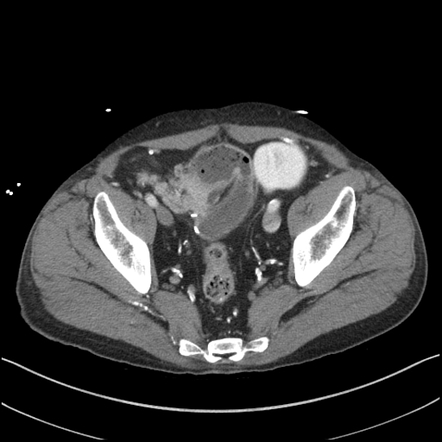 Pancreas transplant | Radiology Reference Article | Radiopaedia.org