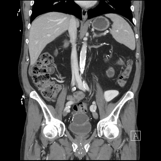 File:SBO, pancreatic and renal transplants (Radiopaedia 78271-90869 ...