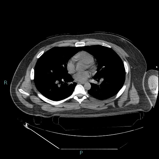 Bronchial carcinoid tumor | Image | Radiopaedia.org