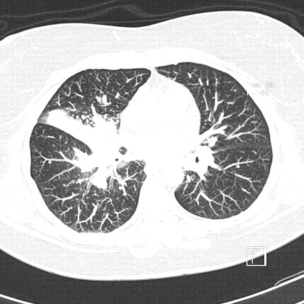 Pulmonary cryptococcosis | Image | Radiopaedia.org