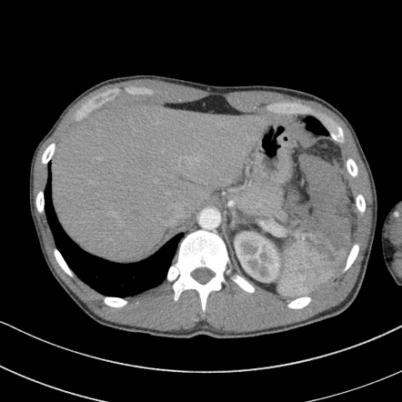 AAST spleen injury scale | Radiology Reference Article | Radiopaedia.org