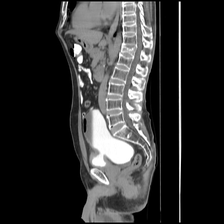 Large Hutch diverticulum causing urinary obstruction | Radiology Case ...