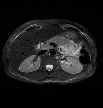 Acute pancreatitis in a pregnant patient | Radiology Case | Radiopaedia.org