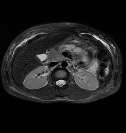 Acute pancreatitis in a pregnant patient | Image | Radiopaedia.org