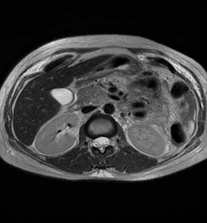 Acute Pancreatitis In A Pregnant Patient 