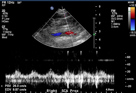 Arterial Doppler in left ventricular assist device patients | Radiology ...